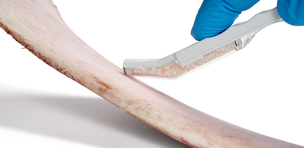 Bone Scraper Anwendung am Knochen: Der Knochen wird entnommen, indem das vordere Ende mit der Klinge des Knochensammlers auf die Knochenoberflaeche gedrueckt und der Bone Scraper gleichzeitig nach hinten gezogen wird.